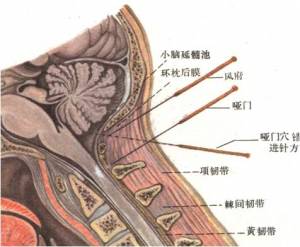 {{:acupuncture:points:vg:16vg.jpg?nolink&500 |